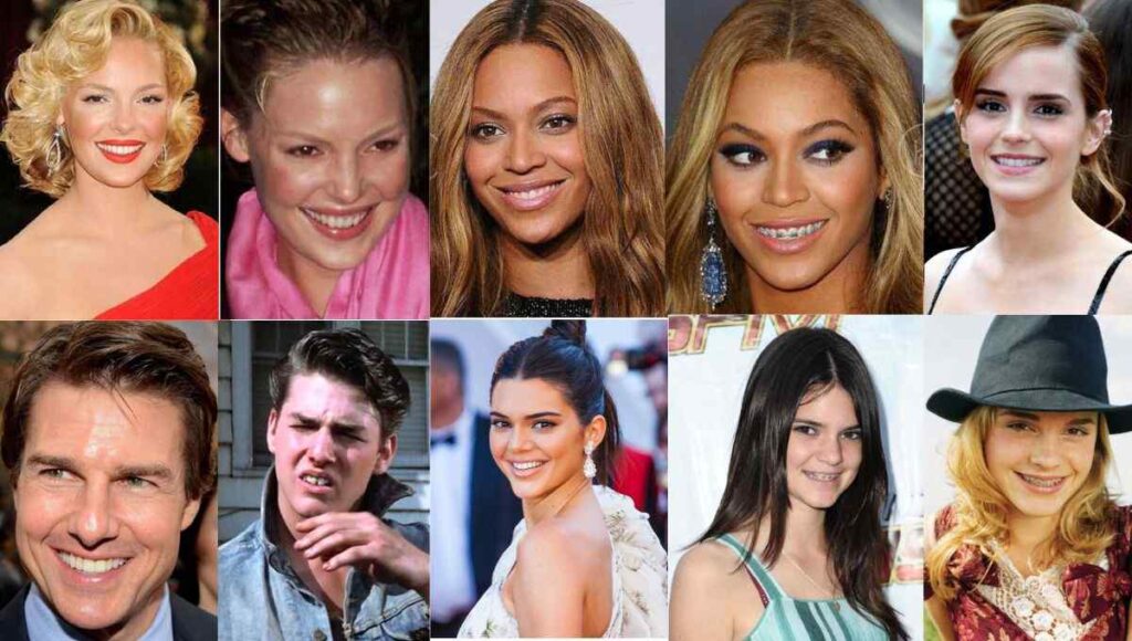 Famous Celebrities That Have Braces